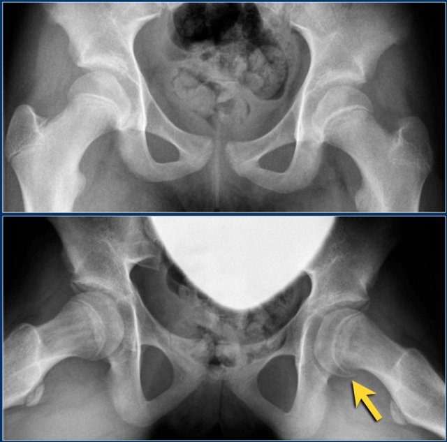 Slipped epiphysis in a thirteen-year old boy. AP radiograph shows a slightly widened epiphysis, but this can easily be overlooked. The frog-leg lateral view shows a medio-posterior slippage of the left femoral epiphysis.