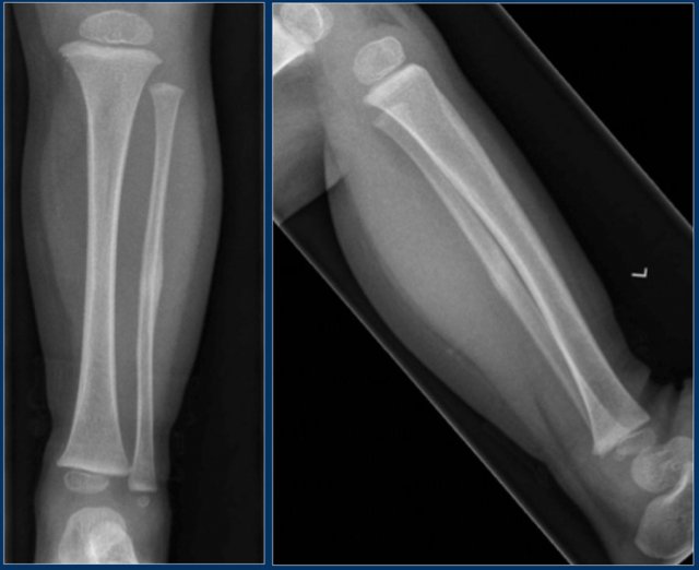 Periosteal reaction of the fibula in a fibular Toddler's fracture.