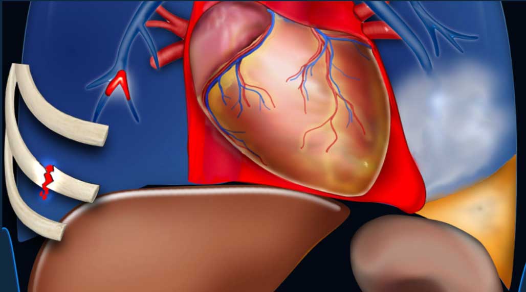 Thoracic Ultrasound in Acute Abdomen