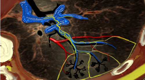 HRCT - Basic Interpretation