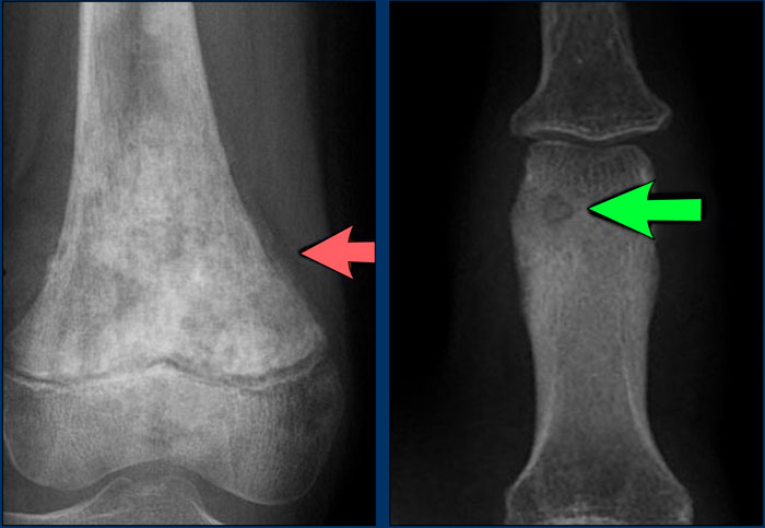 Osteoid matrix in Osteosarcoma (left) and Osteoid osteoma (right).