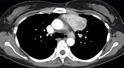 Thymic masses and mimics