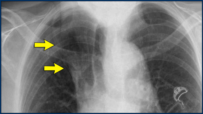 Vena azygos lobe, seen as a fine line that crosses the apex of the right lung.