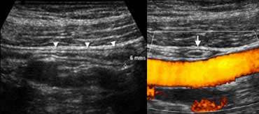 Normal appendix : Longitudinal (A) sonogram depicts a blind-ending tubular structure (arrowheads) with 'gut-signature', with a maximum outer diameter of 6 mm, with noninflamed surrounding fat. On an axial view (B) the appendix can be compressed crossing the iliac vessels.