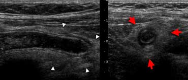 Inflamed appendix at sonography. Longitudinal (A) and transverse (B) cross-section show a distended noncompressible appendix, surrounded bij hyperechoic inflamed fat (arrowheads).