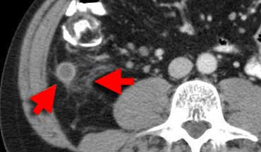 Inflamed appendix at CT. The appendix (arrows) is fluid-filled and distended with periappendiceal fat-stranding.