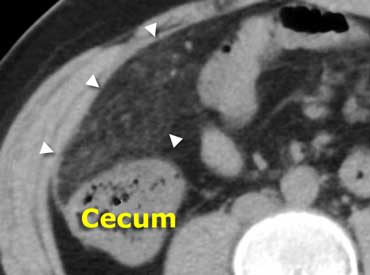 Same patient as above.  Unenhanced CT depicts an area of fatty tissue with slightly increased density (arrowheads), in the right-upper quadrant. Compare this to normal low-density subcutaneous fat. Diagnosis: omental infarction.