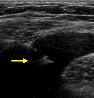 Clinically appendicitis. US only showed a little bit of ascites. A diagnostic puncture (arrow marks needletip) revealed blood. In a woman this finding is very suspicious of an EUG.