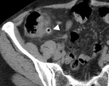 CT  shows an inflamed cecal diverticulum (arrowhead) with regional colonic wall thickening.