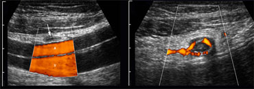 LEFT: The normal appendix is small, compressible, contains no Doppler signal, and is not surrounded by inflamed fat .RIGHT: The inflamed appendix is large, non-compressible and hypervascular, and is surrounded by  hyperechoic, non-compressible tissue, representing the fatty mesoappendix