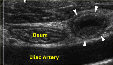 Acute appendicitis. Noncompressible, inflamed appendix (arrowheads) lies next to the normal well-compressable ileum. The lumen is dilated and the diameter is 11 by 13 mm. Note the fluid-debris level within the lumen.