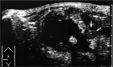 Appendiceal abscess containing fecolith next to inflamed appendix (arrows).