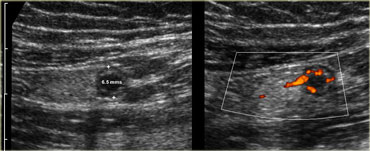 Pitfall. Acute appendicitis, but appendix has a diameter of only 6.5mm. However there is inflamed fat and an increased Doppler signal indicating that it is acutely inflamed.