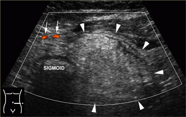 Epiploic appendagitis in a 48-year old man with clinical signs of diverticulitis