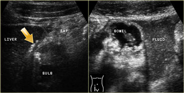 LEFT: In the right upper quadrant wall thickening of the duodenal bulb is found. There are both transmural and extramural (arrow) gasconfigurations. The inflamed fat represents mesenterial and omental fat (fat) attempting -in vain- to wall off the perforation. RIGHT: In the right lower quadrant  a large amount of debris-like peritoneal fluid is found.
