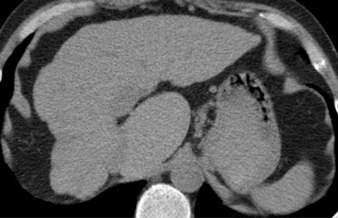 Hypertrophy of caudate lobe in a patient with livercirrhosis. Notice the small lobulated right hemiliver.