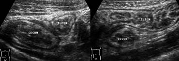 Fig 6.- 39-year-old man with bacterial ileocecitis. A and B, Sonography shows moderate mural thickening of the terminal ileum and cecum, surrounded by normal noninflamed fat. Moderate mesenteric lymphadenopathy was also present (not shown).