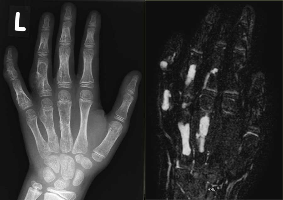 Ollier's disease of the hand