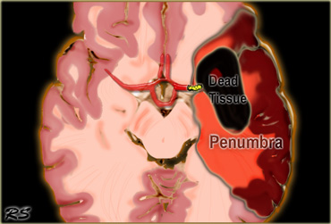 Penumbra: Occlusion of the MCA with irreversibly affected or dead tissue in black and tissue at risk or penumbra in red.