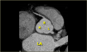 Axial reconstruction depicting the tricuspid aortic valve with its right and left coronary (R and L respectively) and non-coronary cusp (N)