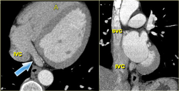 Axial (left) and coronal oblique (right) reconstructions of the heart, depicting the right atrium and its main contributing blood vessels: the coronary sinus (blue arrow) and superior and inferior vena cava. IVC=inferior vena cava, A=anterior, SVC=superior vena cava