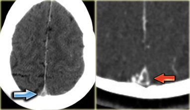 Two cases of empty delta sign due to thrombosis of the superior sagittal sinus.