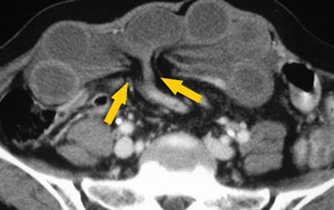 Closed loop obstruction with radial array of dilated loops. There is bowel wall thickening and mesenteric edema indicating ischemia