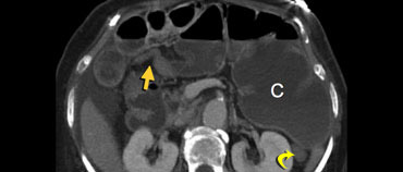 Dilated cecal volvulus (C) shifting away from the area of bowel twist (arrow)