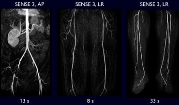 Three station CE-MRA in patient with intermittent claudication. Fast scanning was possible with SENSE.