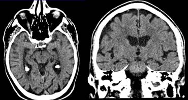 Spiral CT of the brain with coronal reconstructions.