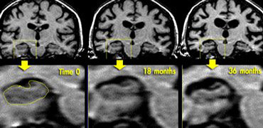 Coronal T1WI of the hippocampus demonstrating progressive atrophy in familial AD (images kindly provided by Nick Fox).