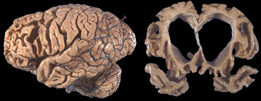 End stage FTLD with striking atrophy of frontal and temporal lobes. No artophy of parietal and occipital lobes. Courtesy Webpath (11).