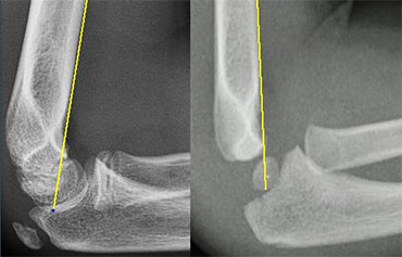 Radiographs of elbows at different ages. The Anterior Humeral line goes through the middle third of the capitellum .