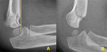 Supracondylar fractures. In A the anterior humeral line passes through the anterior third of the capitellum and in B even more anteriorly. Notice positive posterior fat pad sign in both cases