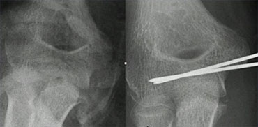 Same case as above. After reduction the epicondyle returned to its normal position (not good visible due to cast) and was fixated with K-wires.