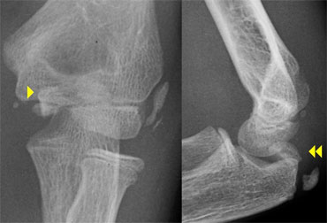 On AP-view the avulsed medial epicondyle projects over the trochlea. Lateral view shows the fragment to be trapped within the joint.