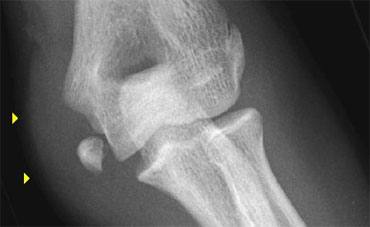 Avulsion of the medial epicondyle. The amount of soft tissue swelling on the medial side suggests that the elbow was dislocated.
