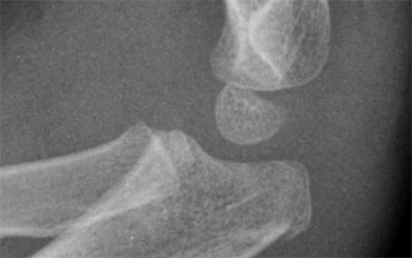Olecranon fracture indicated by discontinuity of the dorsal cortex. No associated fracture.