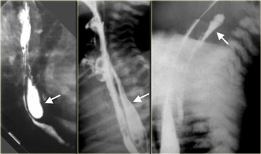 Left: Iatrogenic perforation (arrow). MIDDLE: Communicating esophageal duplication (arrows). RIGHT: Extravasation from iatrogenic perforation of hypopharynx in neonate