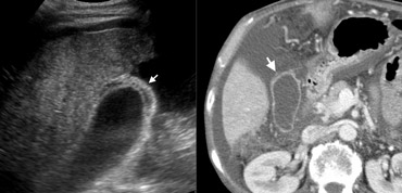 56-year-old man with liver cirrhosisLEFT: US depicts wall thickening (arrow), surrounded by ascites. Note the irregular cirrhotic liver parenchyma. RIGHT: At contrast-enhanced CT the wall of the gallbladder (arrow) appears nearly normal, because subserosal oedema can not be well differentiated from surrounding ascites at CT.