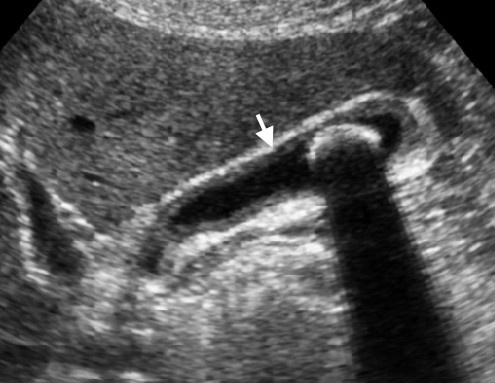 Chronic cholecystitis. Longitudinal sonogram of the gallbladder shows slight wall thickening (arrow) and an intraluminal non-obstructing stone