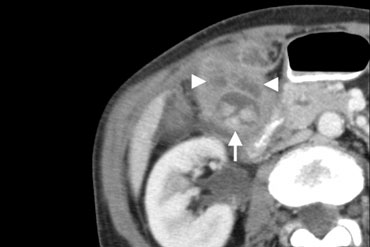 Xanthogranulomatous cholecystitis. Hypoattenuating nodules ( arrowheads) represent abscesses. The lumen contains several stones (arrow).