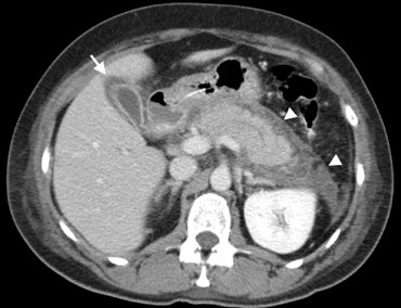 Pancreatitis in a 56-year-old man Contrast-enhanced CT shows peripancreatic inflammatory changes (arrowheads), and thickening of the wall of the gallbladder (arrow) which is secondarily involved in the pancreatic inflammation.