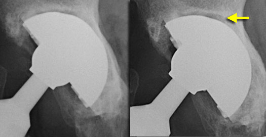 Progressive lucent zone around acetabular component in zone I and II. Steeper position of the cup indicates migration. Subtle excentric positioning of the femoral head is indicative of polyethylene wear.