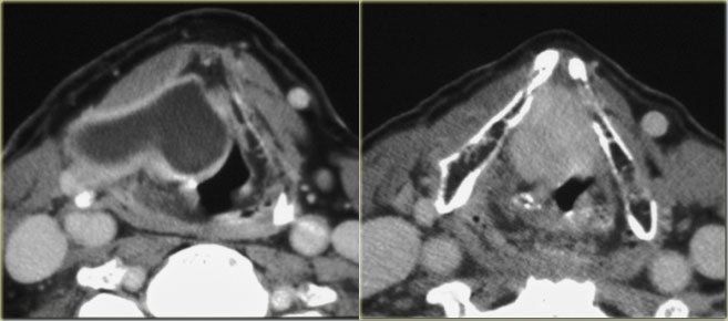 Laryngocele (courtesy: Ilona Schmallfuss)