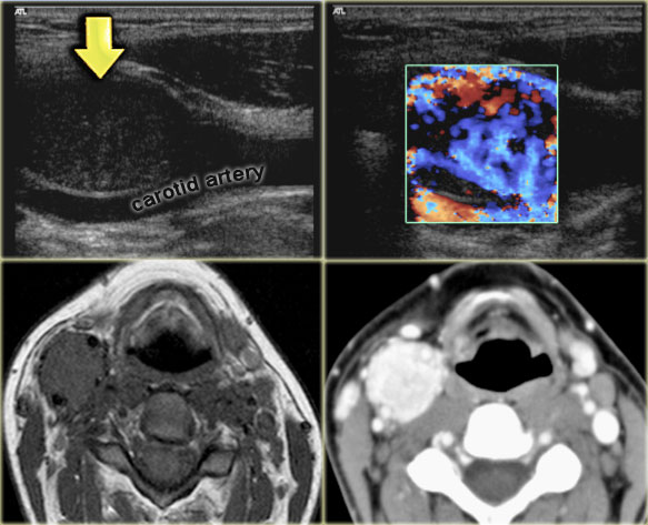 Paraganglioma: Ultrasound with color doppler, T1-weighted non-contrast MR and CECT