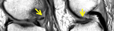 LEFT: abnormal shape of posterior horn. A piece is missing. RIGHT: displaced fragment in the intercondylar fossa.