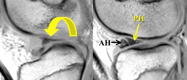 Flipped meniscus: posterior horn is missing because it is flipped over and located on top of the anterior horn.