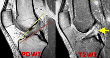 LEFT: Acute ACL-tear. ACL fibers too flat compared to condylar roof.RIGHT: Discontinuity of fibers.