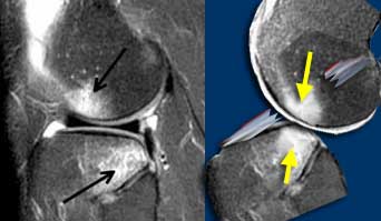 LEFT: ACL-tear with bone bruises on lateral side. RIGHT: Anterior condyle hits the posterior part of the tibia. ACL torn due to stretching.